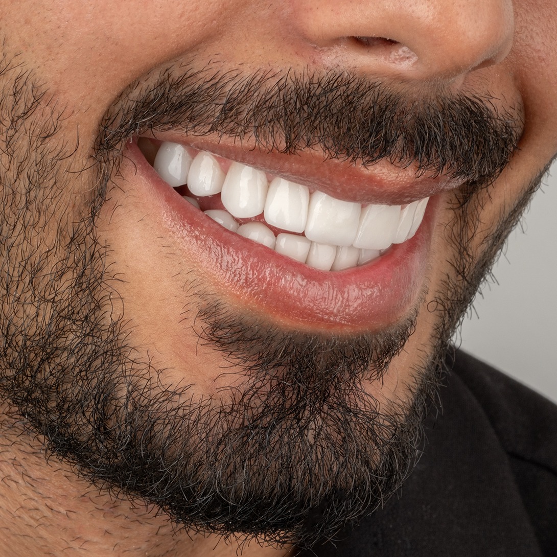 Nachher – Hollywood Smile