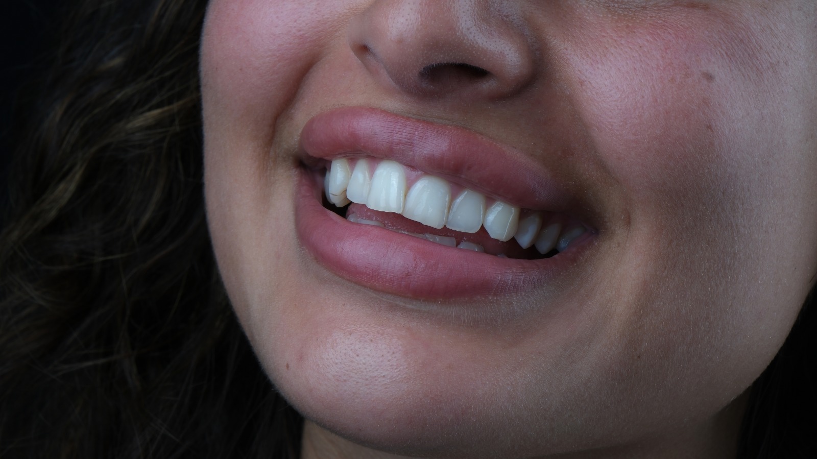 Vorher – Laminat Veneers