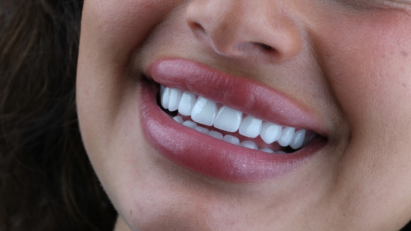 Nachher – Laminat Veneers