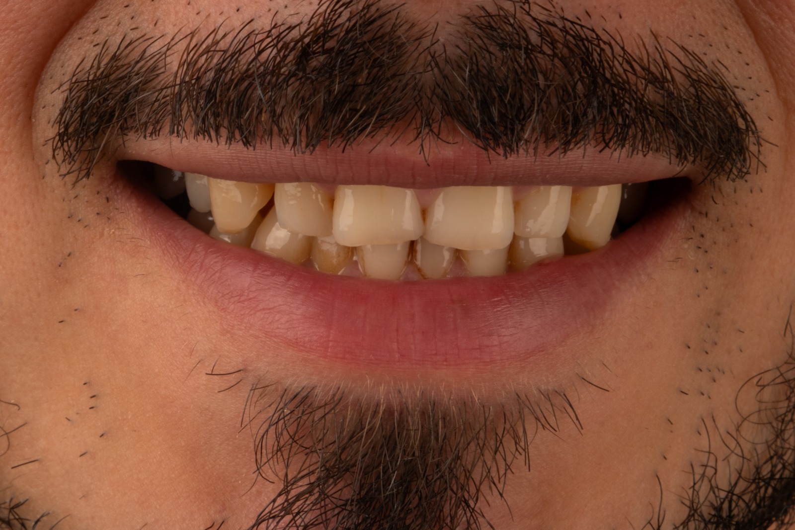 Vorher – Hollywood Smile