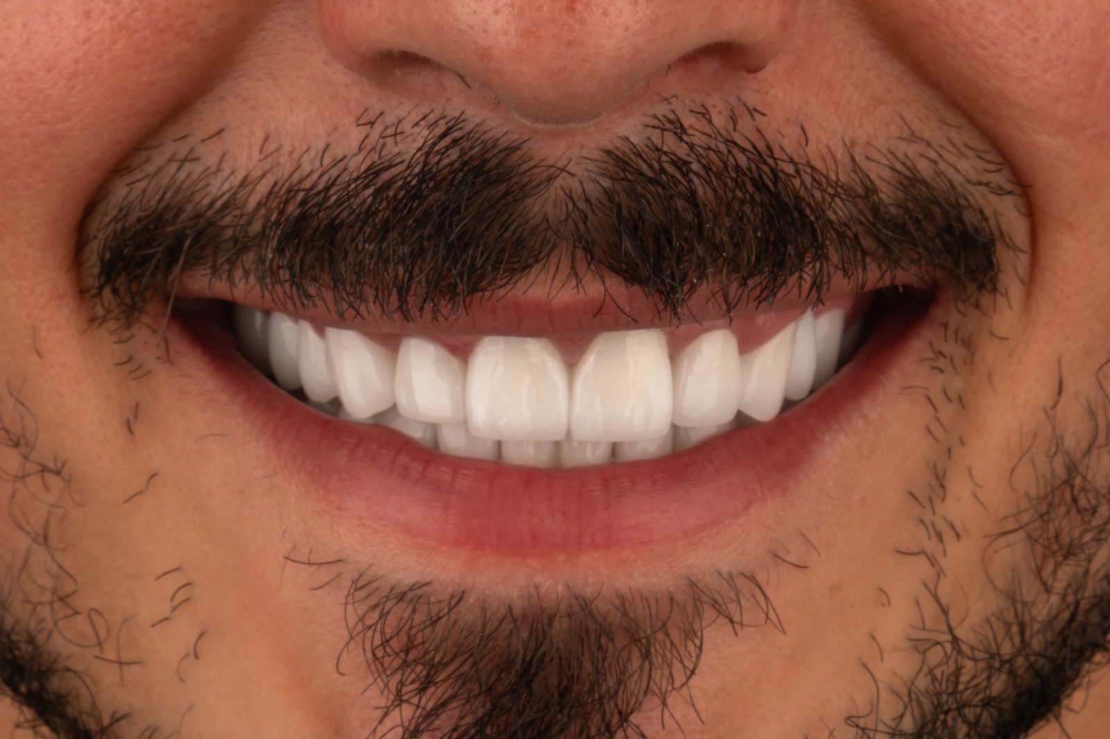 Nachher – Hollywood Smile