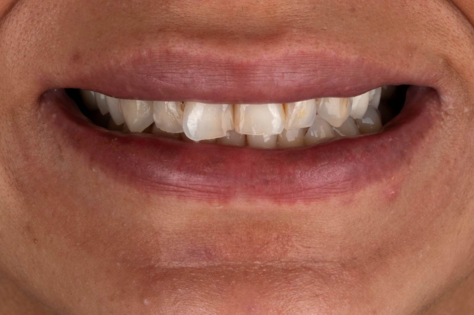 Vorher – Emax Kronen