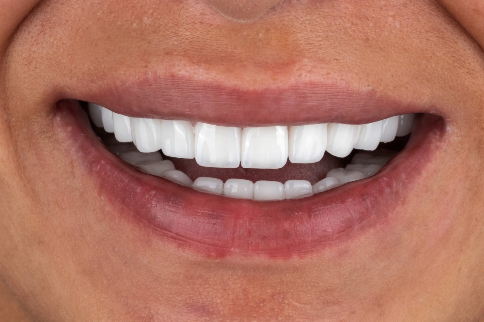 Nachher – Emax Kronen