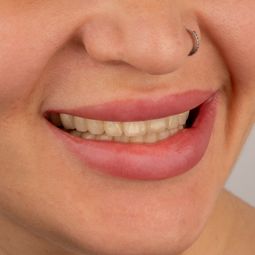 Vorher – Laminat Veneers