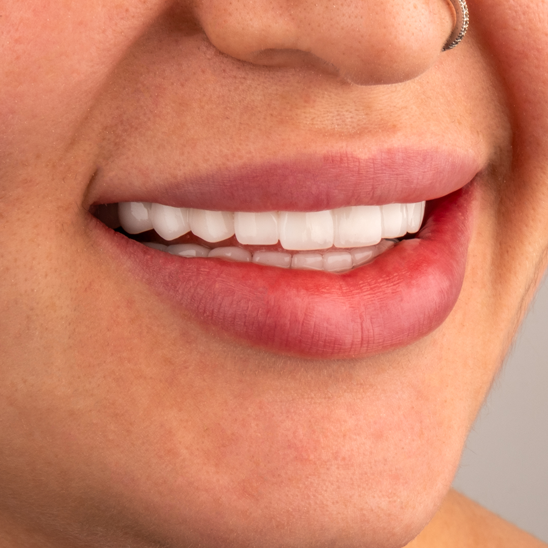 Nachher – Laminat Veneers