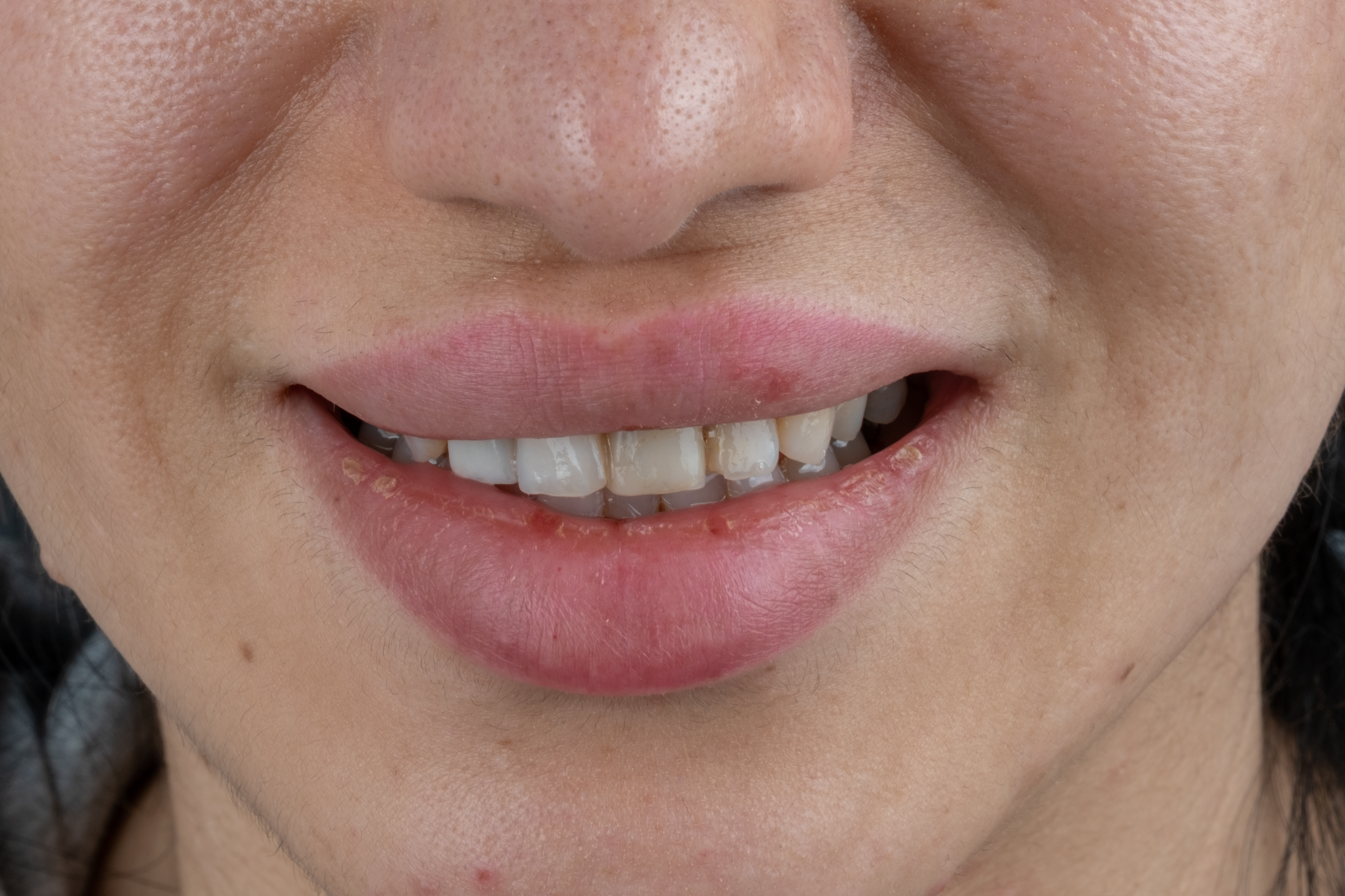 Vorher – Zirkonium Kronen