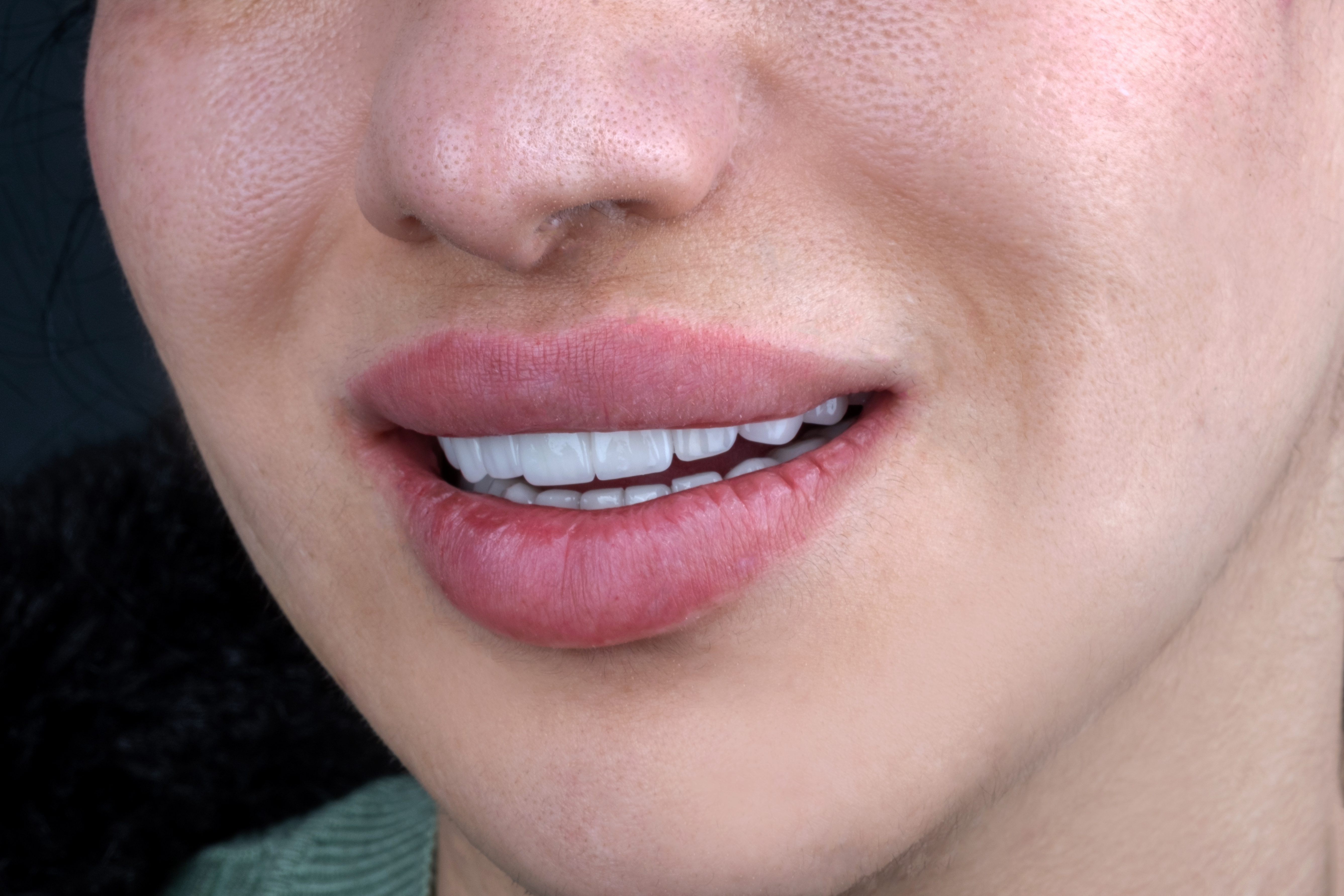 Nachher – Zirkonium Kronen