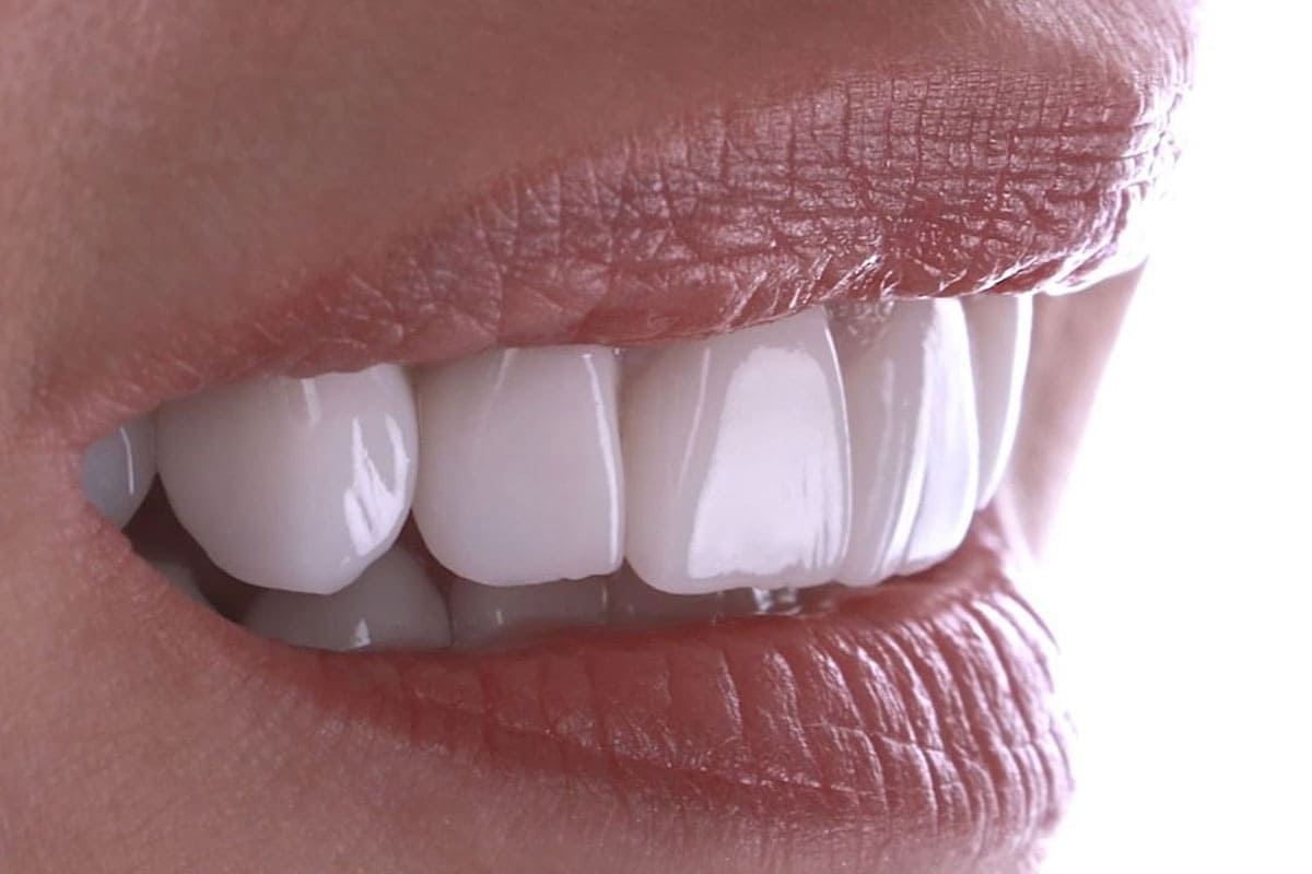 Emax Zähne vs Zirkon Zähne: Ihr Guide für Istanbul