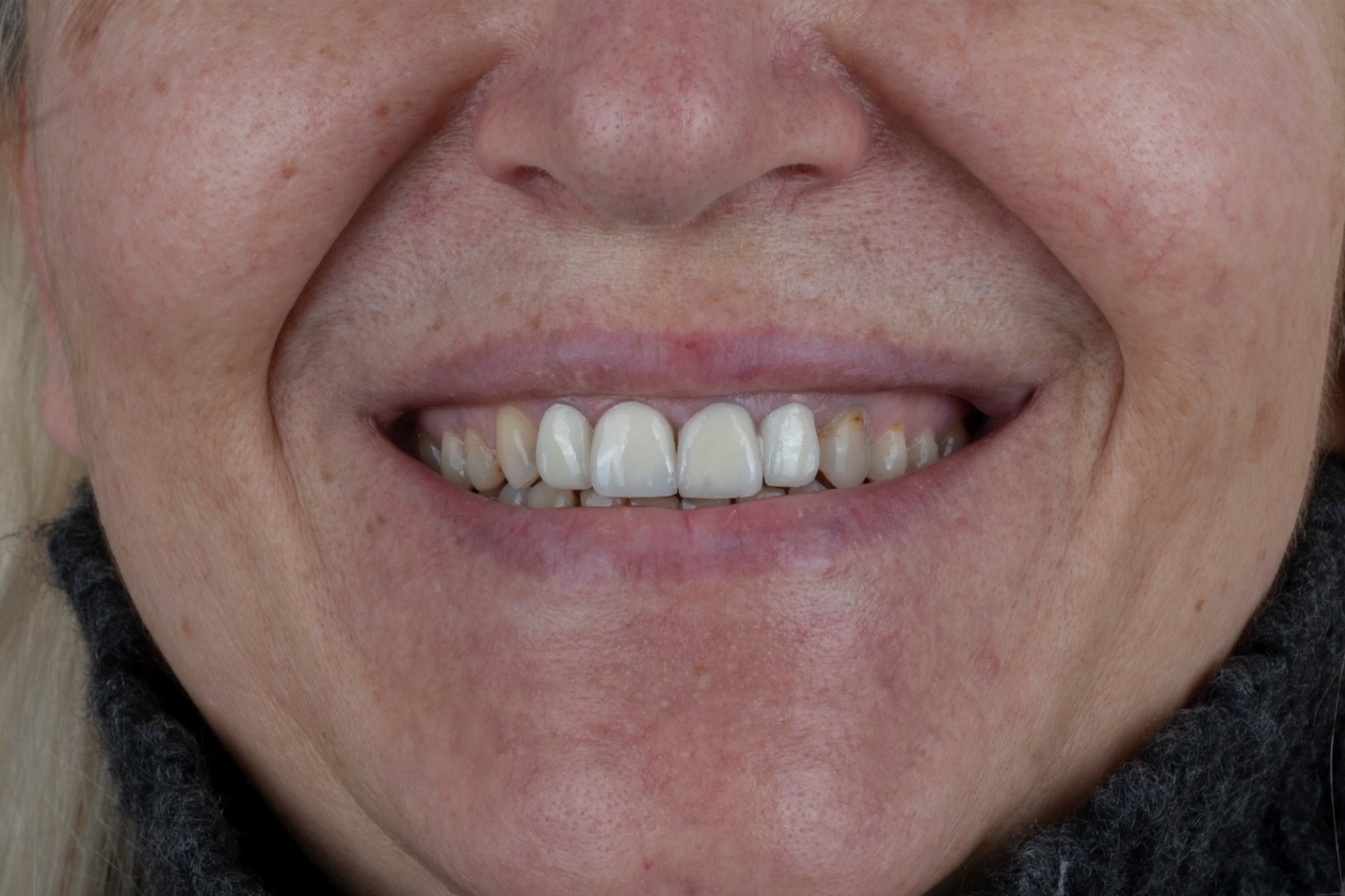 Vorher – Laminat Veneers