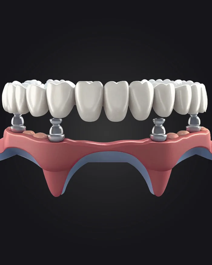 All-on-4 Implantat: Feste Zähne günstig in Istanbul