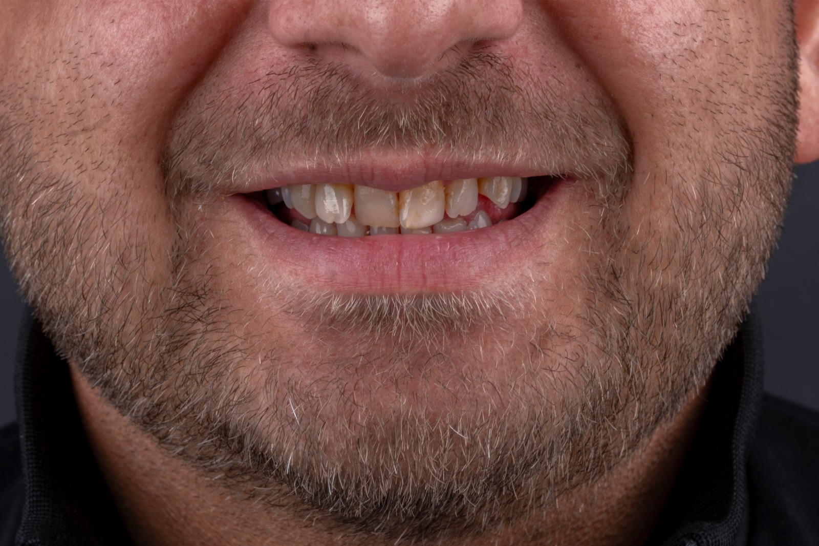 Vorher – Zirkonium Kronen