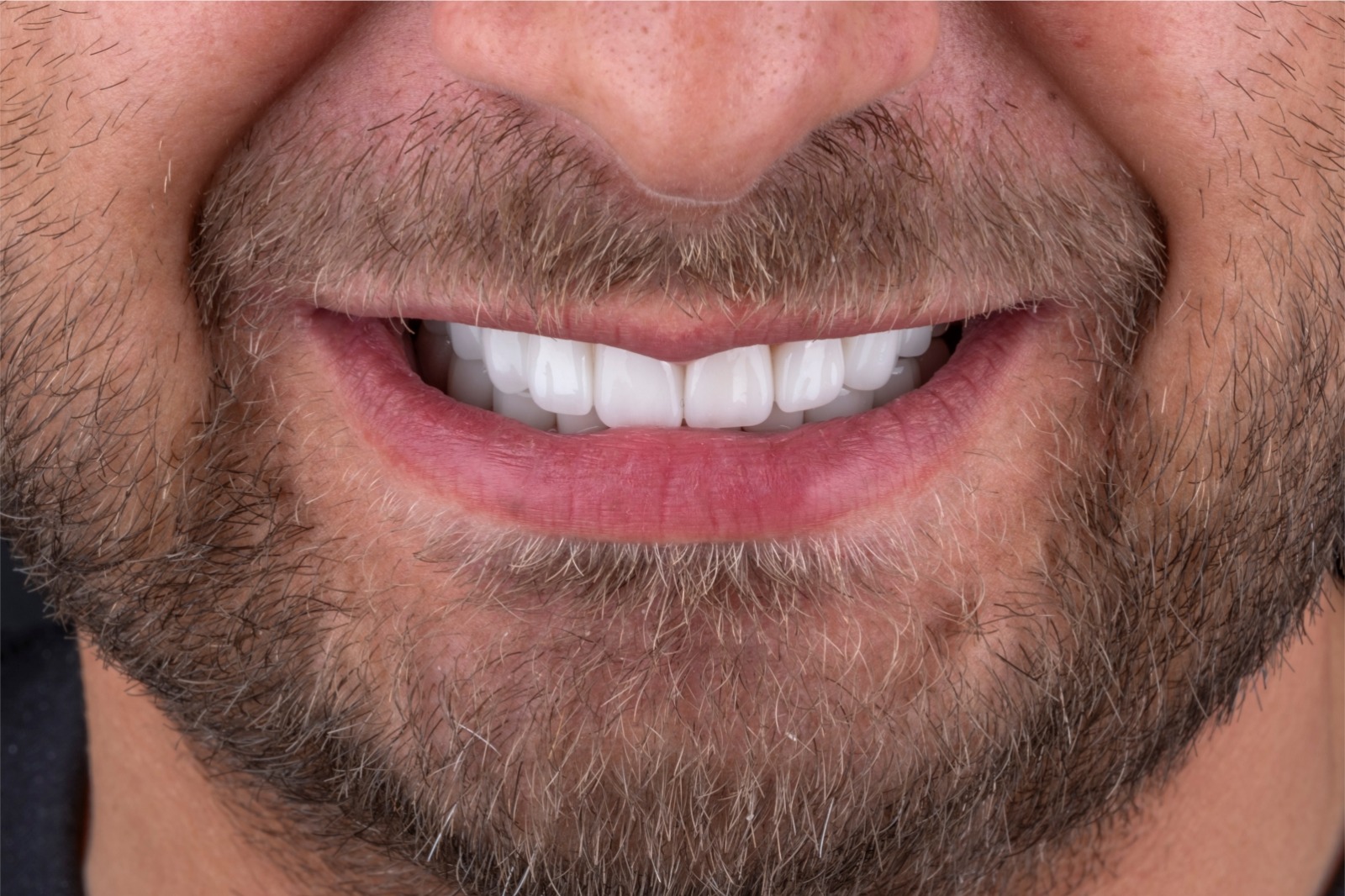 Nachher – Zirkonium Kronen