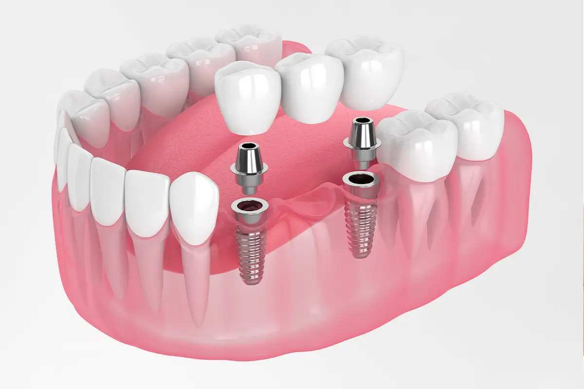 Zahnimplantat Türkei Preis: Ihr Weg zu einem strahlenden Lächeln in Istanbul