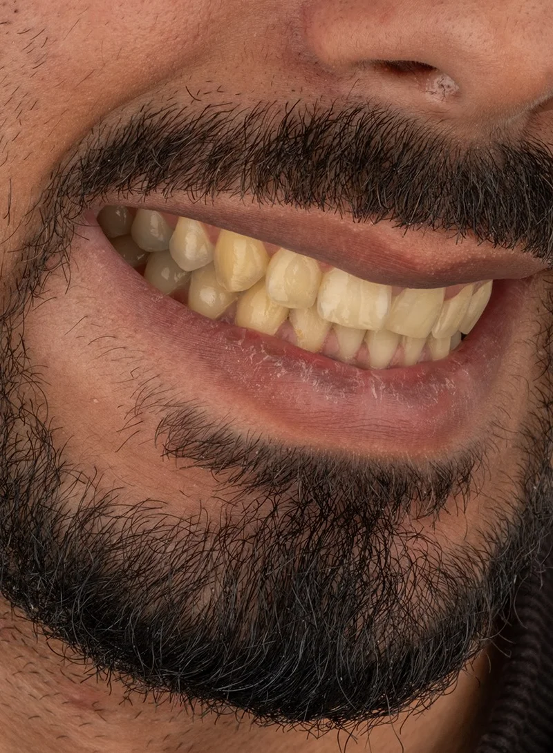 Hollywood Smile avant – Türkiye Dental Istanbul Avant – Hollywood Smile | Türkiye Dental