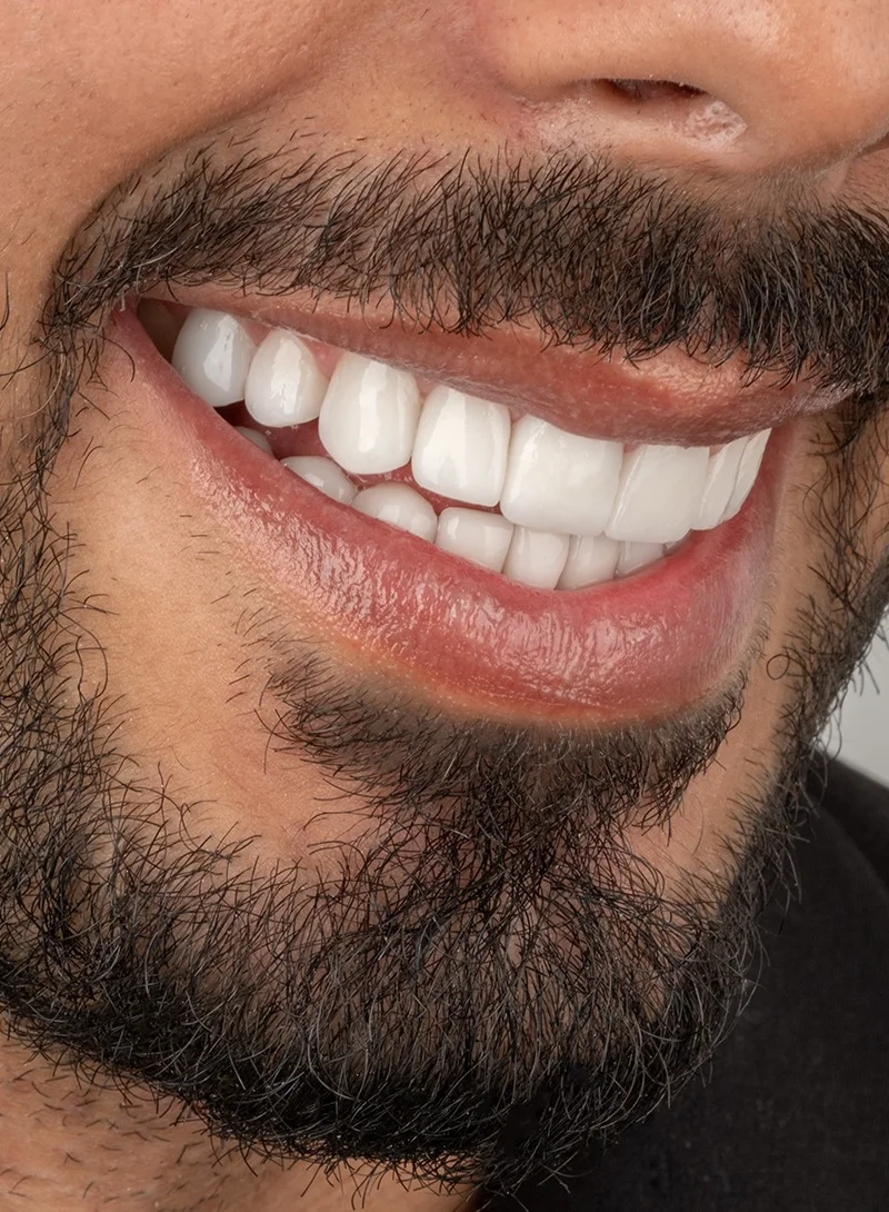 Hollywood Smile résultat après – Türkiye Dental Istanbul Après – Hollywood Smile | Türkiye Dental
