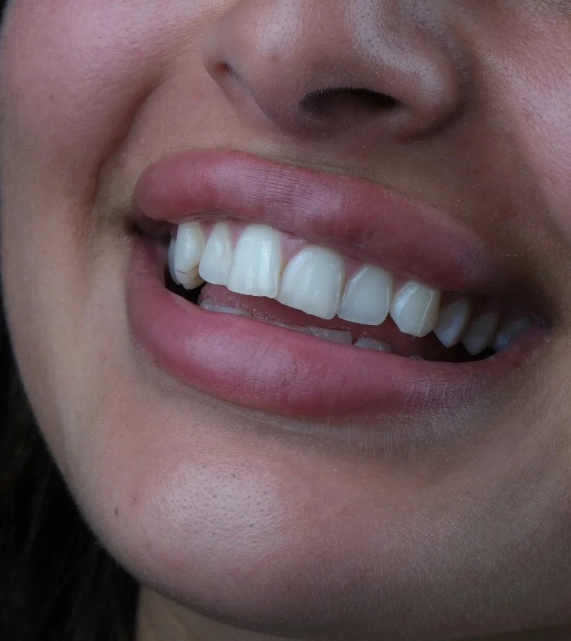 Facettes Laminées avant – Türkiye Dental Istanbul Avant – Facettes Laminées | Türkiye Dental