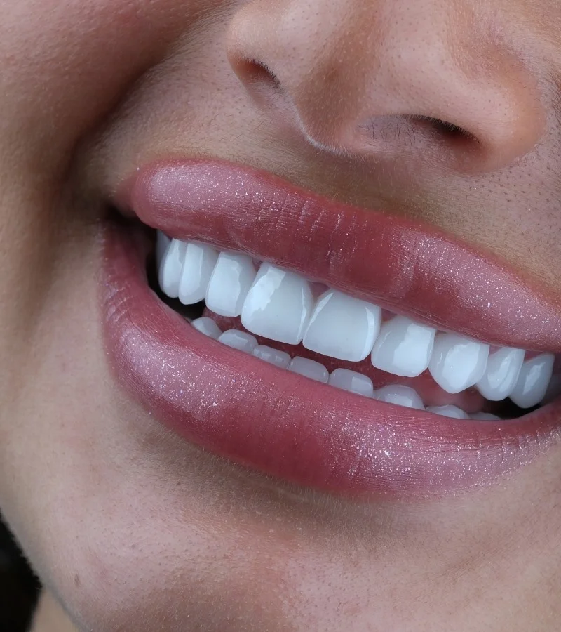Facettes Laminées résultat après – Türkiye Dental Istanbul Après – Facettes Laminées | Türkiye Dental