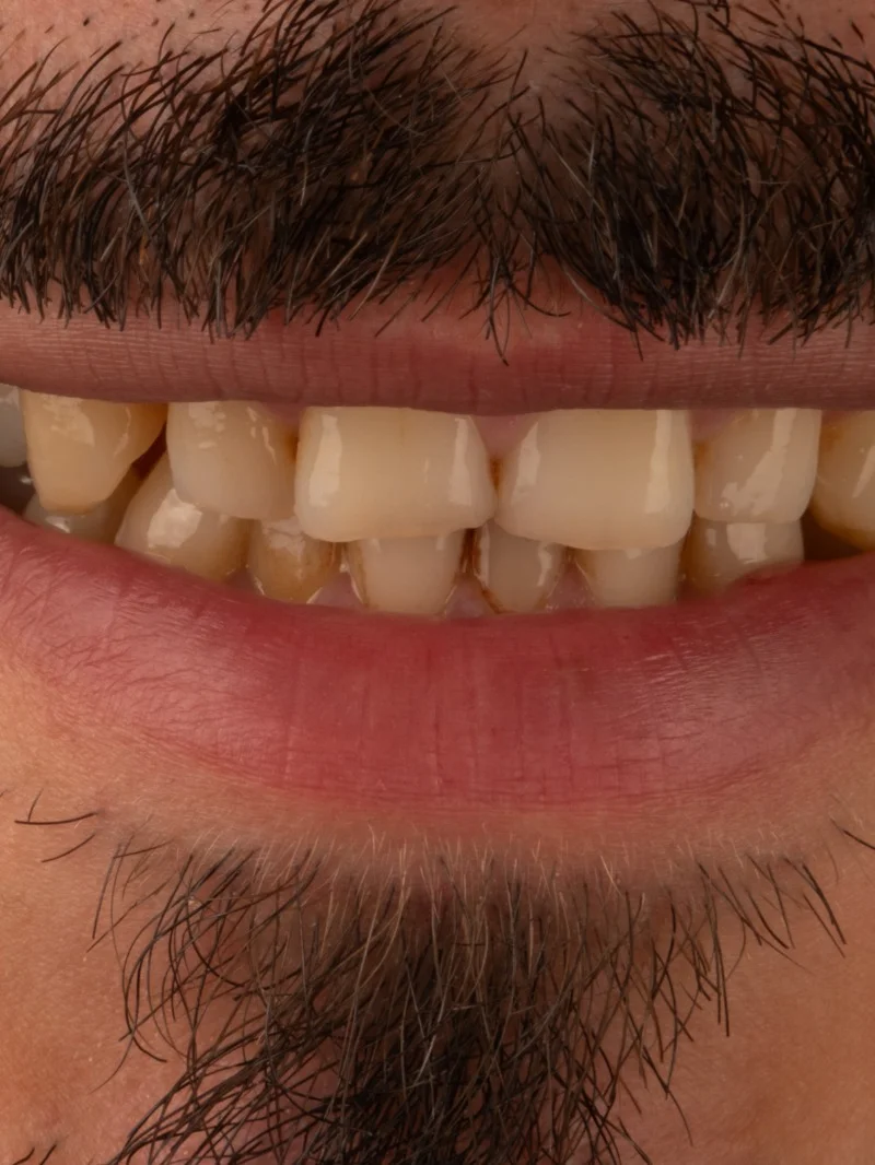 Hollywood Smile avant – Türkiye Dental Istanbul Avant – Hollywood Smile | Türkiye Dental
