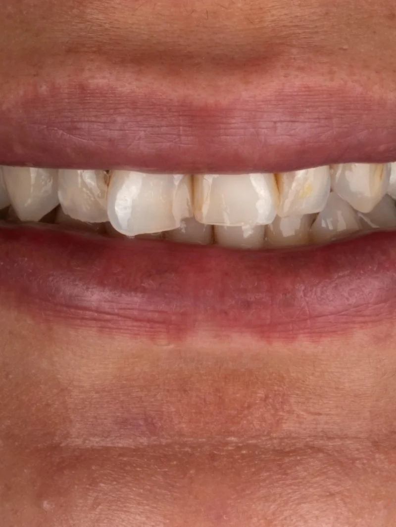 Couronnes Emax avant – Türkiye Dental Istanbul Avant – Couronnes Emax | Türkiye Dental
