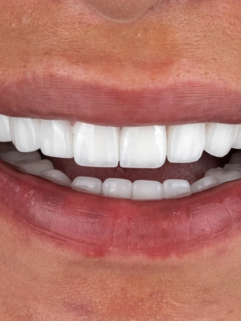 Couronnes Emax résultat après – Türkiye Dental Istanbul Après – Couronnes Emax | Türkiye Dental