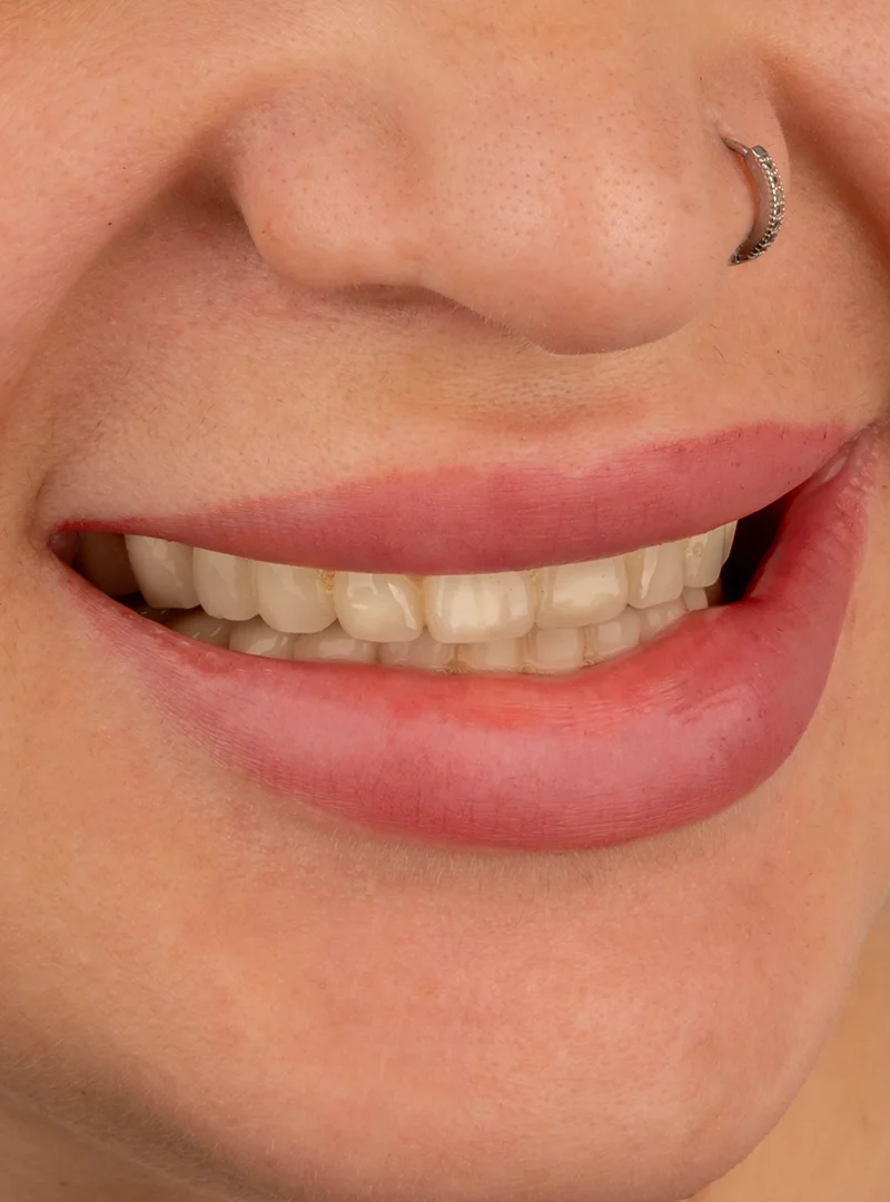 Facettes Laminées avant – Türkiye Dental Istanbul Avant – Facettes Laminées | Türkiye Dental