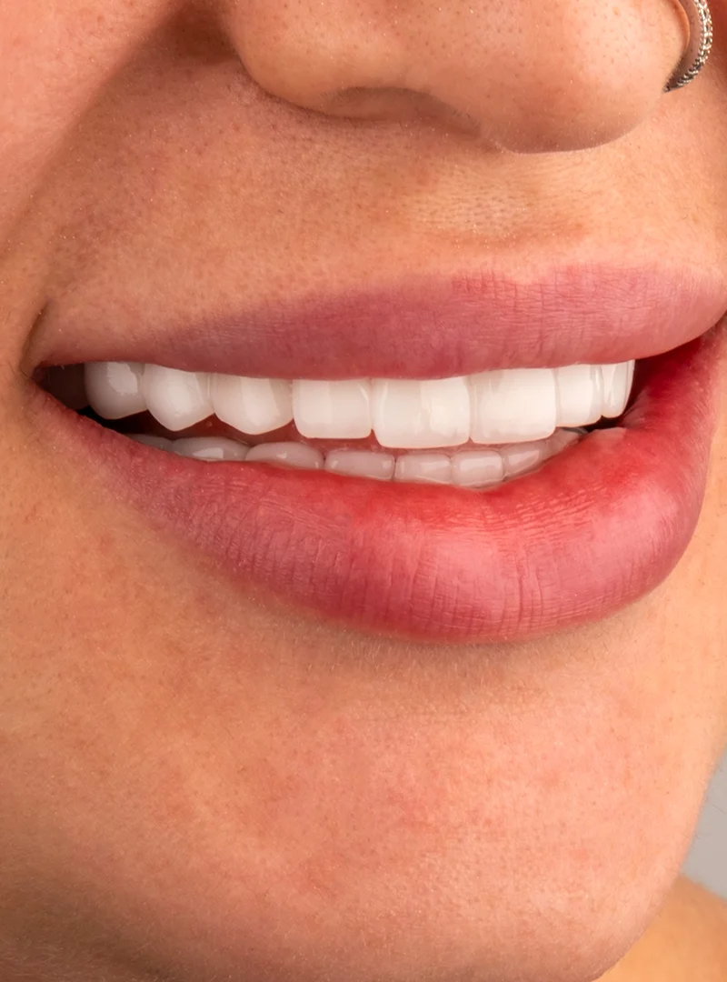 Facettes Laminées résultat après – Türkiye Dental Istanbul Après – Facettes Laminées | Türkiye Dental