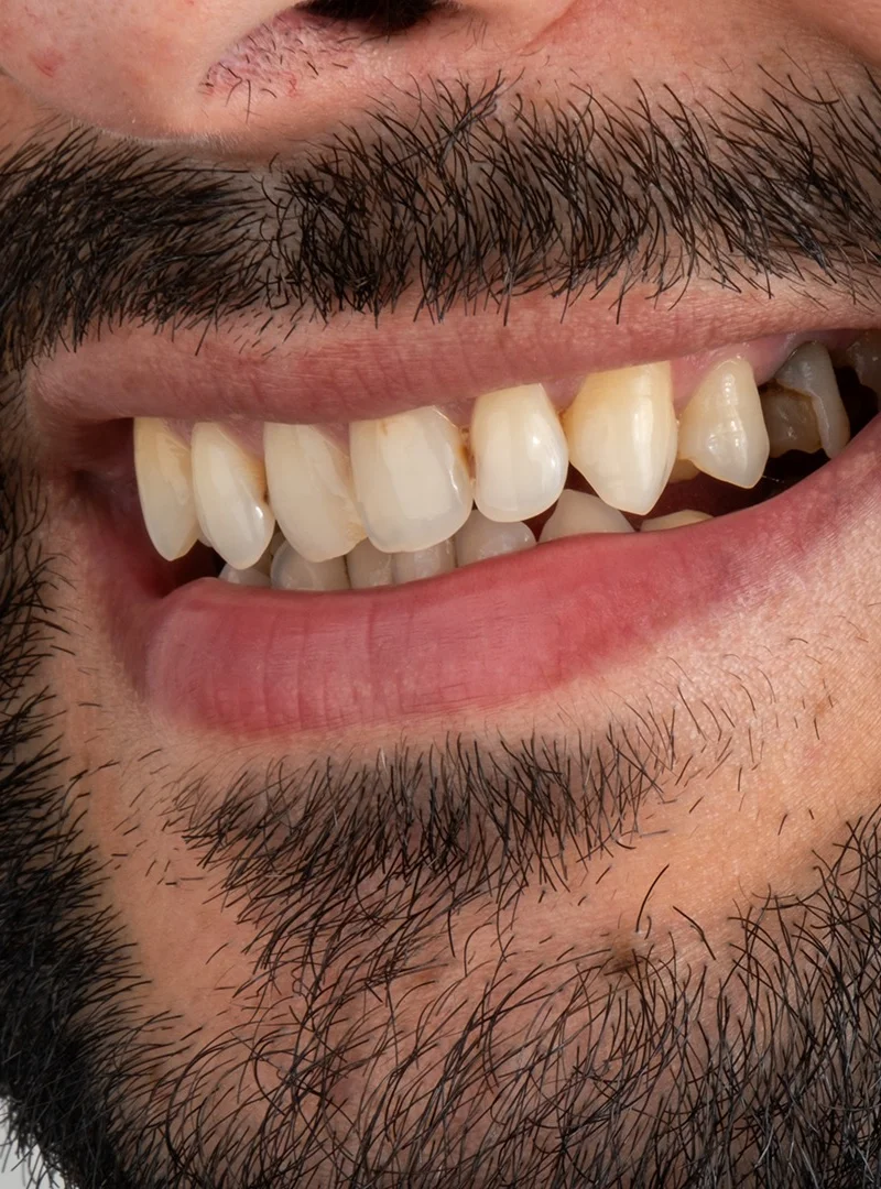 Couronnes Zircone avant – Türkiye Dental Istanbul Avant – Couronnes Zircone | Türkiye Dental