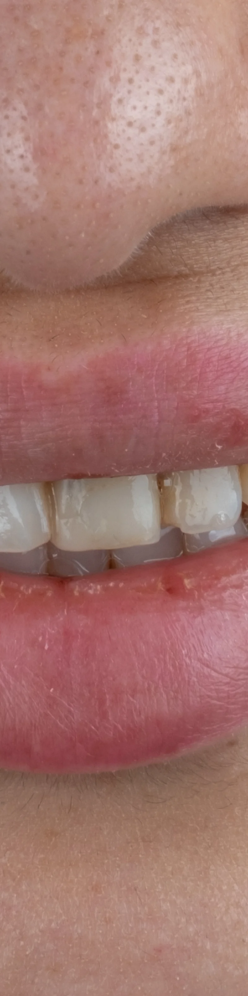 Couronnes Zircone avant – Türkiye Dental Istanbul Avant – Couronnes Zircone | Türkiye Dental