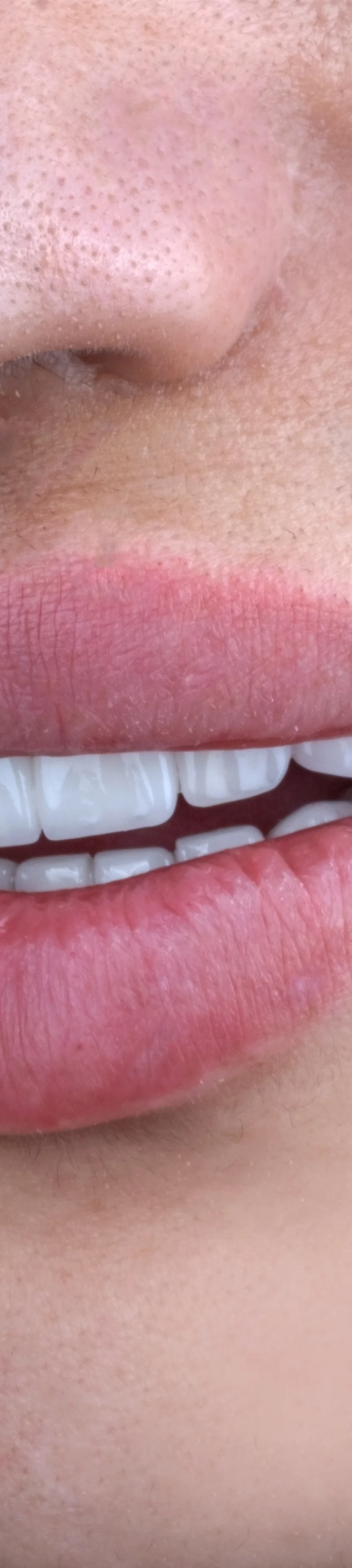 Couronnes Zircone résultat après – Türkiye Dental Istanbul Après – Couronnes Zircone | Türkiye Dental