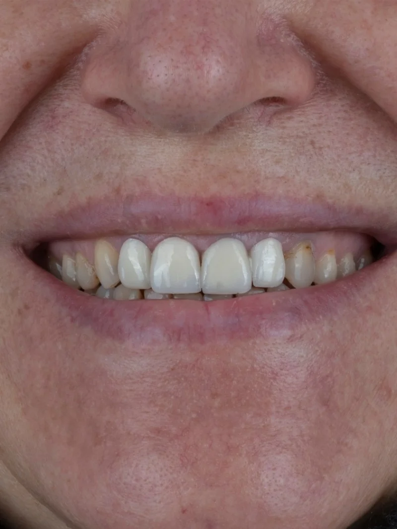 Facettes Laminées avant – Türkiye Dental Istanbul Avant – Facettes Laminées | Türkiye Dental