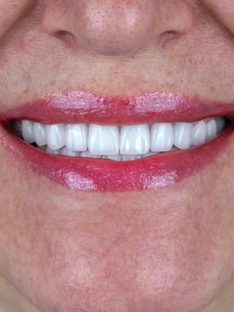 Facettes Laminées résultat après – Türkiye Dental Istanbul Après – Facettes Laminées | Türkiye Dental
