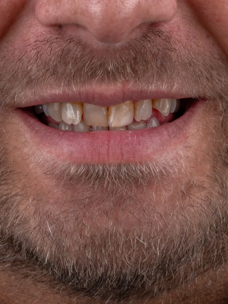 Couronnes Zircone avant – Türkiye Dental Istanbul Avant – Couronnes Zircone | Türkiye Dental