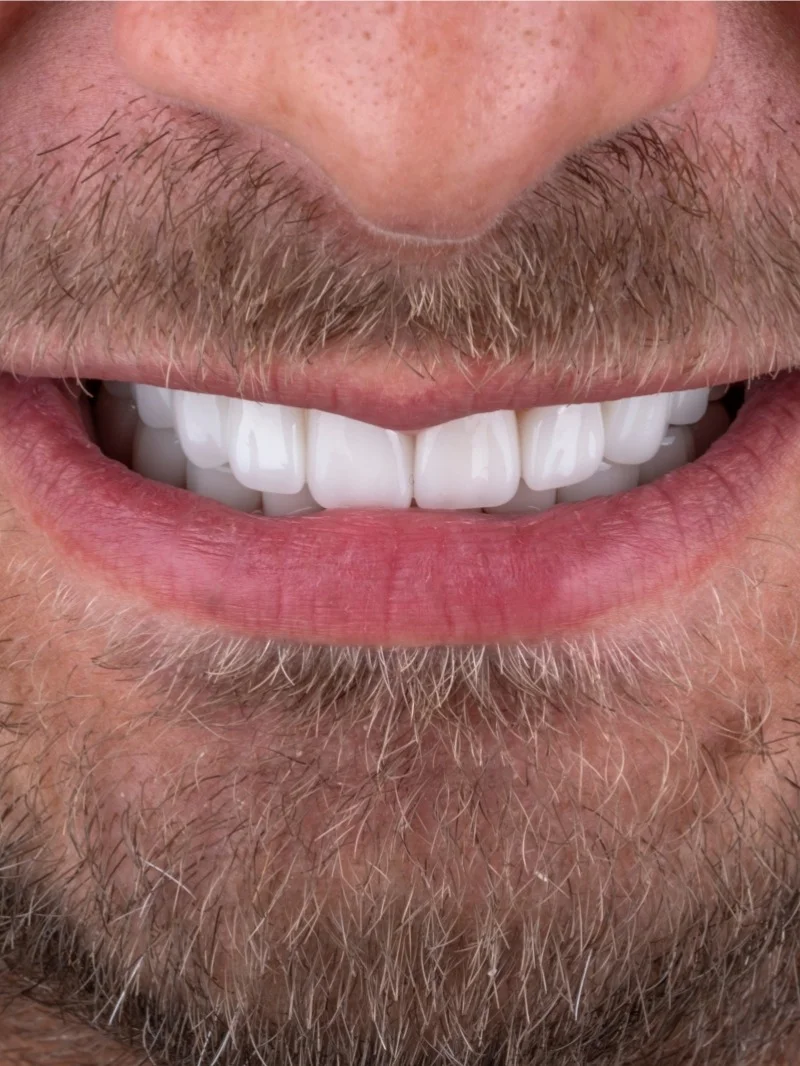 Couronnes Zircone résultat après – Türkiye Dental Istanbul Après – Couronnes Zircone | Türkiye Dental